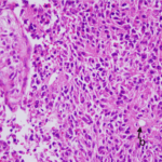 Cancer Cells Glow and Die